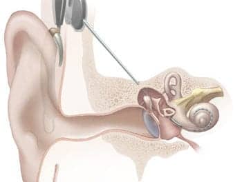 Study Finds Older Age at Revision Cochlear Implantation Is No Issue