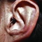 A Simple and Expedient Method to Facilitate Receiver-in-Canal (RIC) Non-custom Tip Insertion