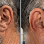 Why Choose Custom Hearing Aids?