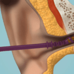 Earways Medical Patent for Cerumen Removal Innovation Approved